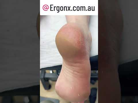 Dry Heel Transformation: Watch a Podiatrist Remove Calluses #FootCare #Podiatry