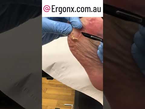 Satisfying Callus Removal! Watch a Podiatrist Transform Painful Feet #CallusRemoval #Podiatry