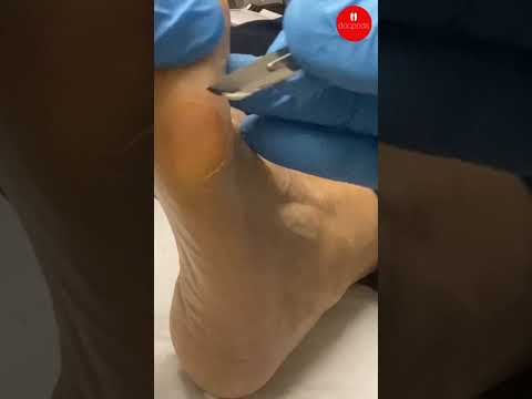 Dance Calluses: Pressure, Footwear and Care