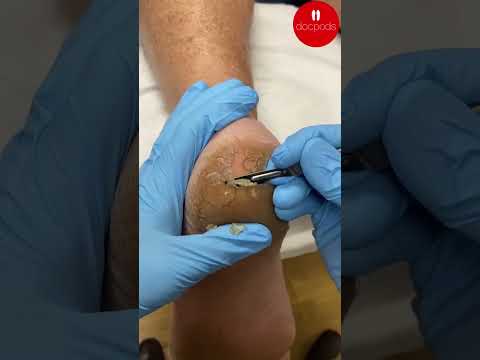 Watch the mesmerizing transformation as thick, cracked heels get a makeover in this satisfying