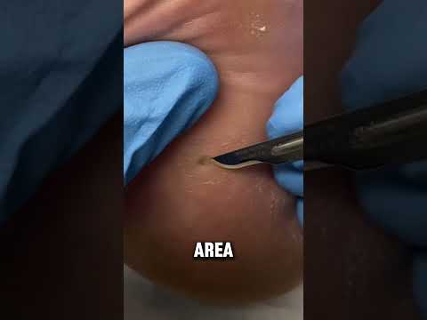 Not Every Painful Heel Is Plantar Fasciitis… When a patient points to a painful spot on the inside