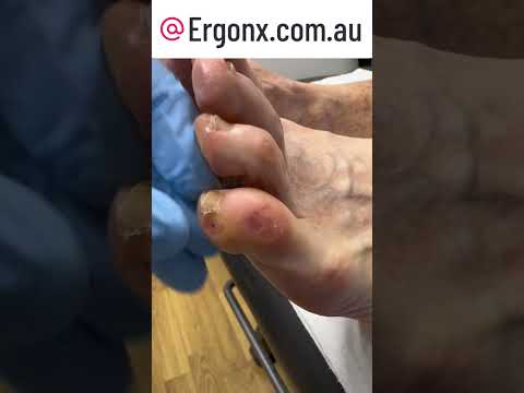 Satisfying Corn Removal from Little Toe Nail by Podiatrist Surgery ASMR #FootCare #Podiatry
