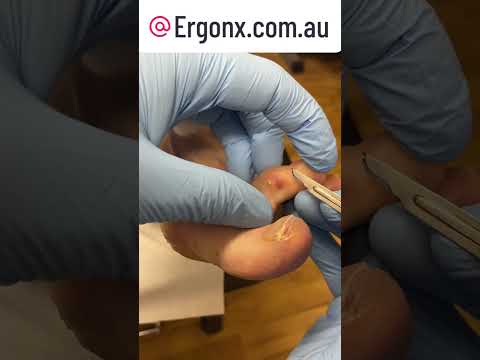Satisfying Corn Removal: Podiatrist Cuts Corns Between Toes #FootCare #Podiatry