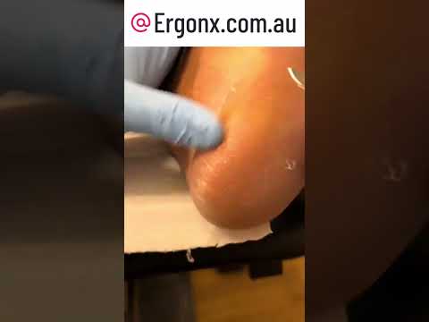 Painful Heel Callus Removal by Podiatrist in Action Watch Now #FootCare #Podiatry