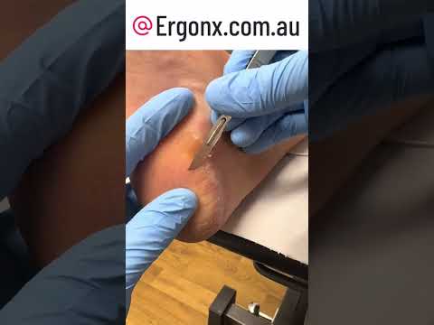 Satisfying Callus Removal Transformation at Podiatry Clinic #Satisfying #Podiatry