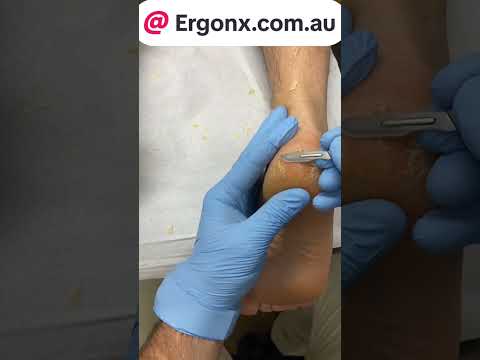 How Podiatrists Treat Cracked Heels & Dry Skin