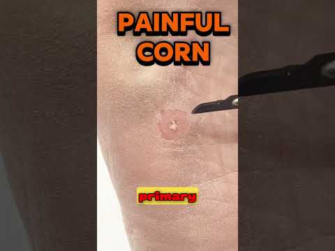 Why Do Some Corns Hurt So Much? In this video, our podiatrist is carefully removing a deep midfoot