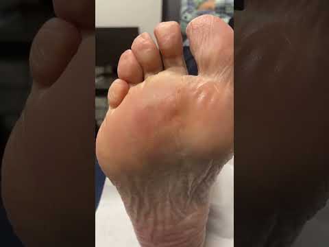 "Say goodbye to that pesky corn on your foot with this easy removal hack! Discover the satisfying