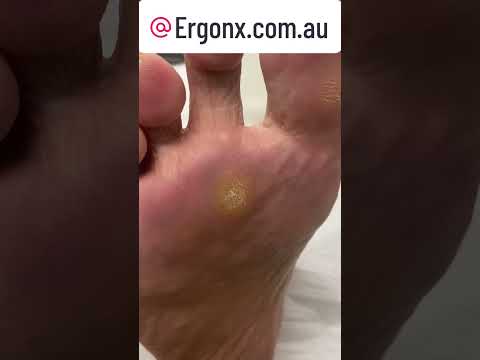 Watch a Corn and Callus Removal at the Podiatry Clinic #FootCare #Podiatrist