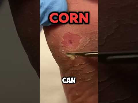 Understanding Plantar Corns and Why They Recur