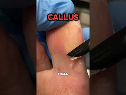 😖 Painful Callus on a Tradie’s Big Toe! Ever wondered why calluses keep coming back? This tradie