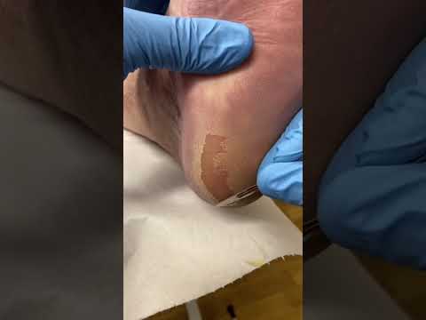 Watch as a podiatrist magically transforms rough heels to smooth bliss! 🌟👣 Say goodbye to calluses