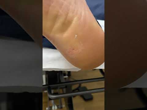 Amazing Heel Corn Removal by Podiatrist #Satisfying #FootCare
