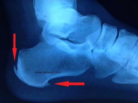 Say goodbye to heel spurs and hello to happy feet! 👣✨ Discover the ultimate relief methods and take