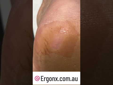 Ultimate Callus Cutting: Satisfying Cracked Heels Transformation #Skincare #CallusCare
