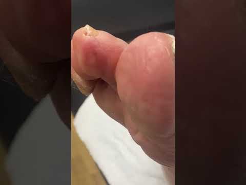 ✨ Watch as a skilled podiatrist works their magic removing a painful corn on the second toe! 👣💥
