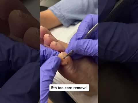 Say goodbye to that pesky corn on your 5th toe! 😲👣 Watch as a skilled podiatrist works their magic