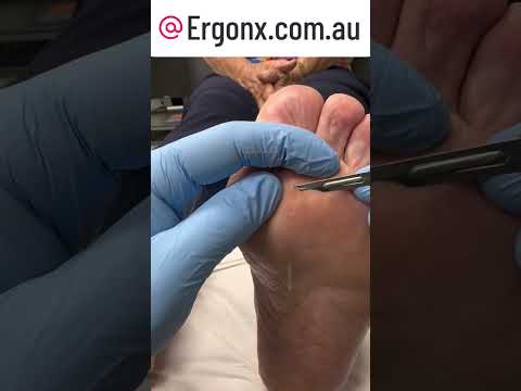Ultimate Relief: Painful Seed Corn Removal at Podiatry Clinic #Podiatry #FootCare