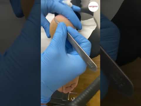Thick Heel Skin Removal: Professional Podiatry Care