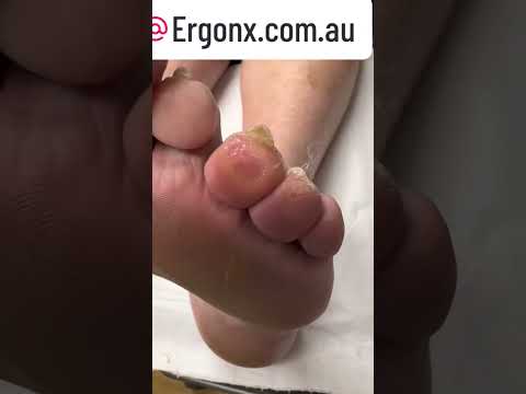 Satisfying Callus Removal with Scalpel Cutting ASMR Podiatry Clinic #FootCare #CallusRemoval