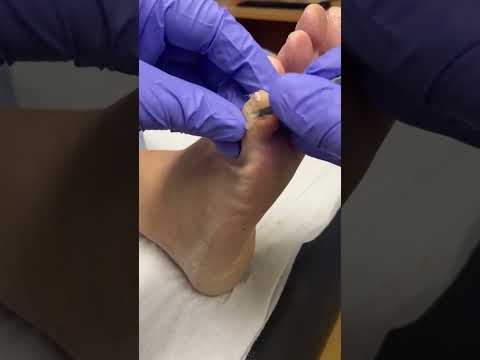 Watch a satisfying corn removal by a skilled podiatrist! Say goodbye to discomfort and hello to
