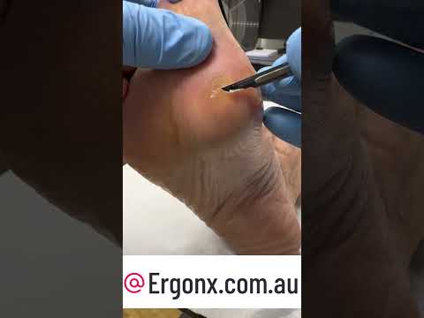 Ultimate Foot Callus Transformation by Podiatrist in Australia #Satisfying #CallusRemoval