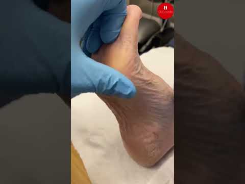 Say goodbye to painful pinch calluses with this Tyloma removal hack! 😮🦶✨ Watch how smooth &