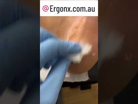 Podiatrist's Secret: Watch Incredible Heel Callus Removal #FootCare #Podiatrist