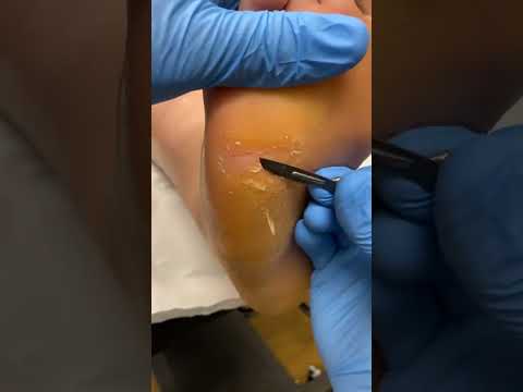 Podiatrist's Secret to Healing Cracked Foot Skin #FootCare #PodiatristTips