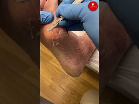 Bunion Calluses and Skin Cracks: Podiatry Care