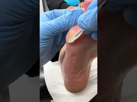 Satisfying Callus Removal: Watch a Podiatrist Transform Tough Feet #FootCare #CallusRemoval