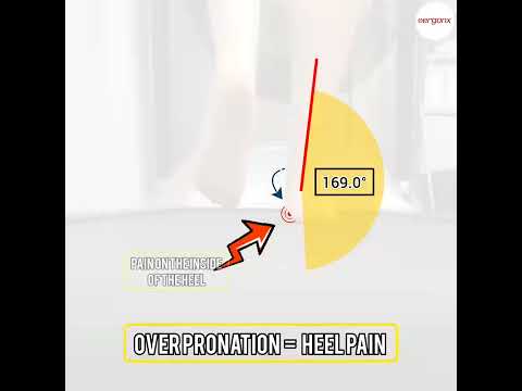 Overpronation and Heel Pain: What to Know