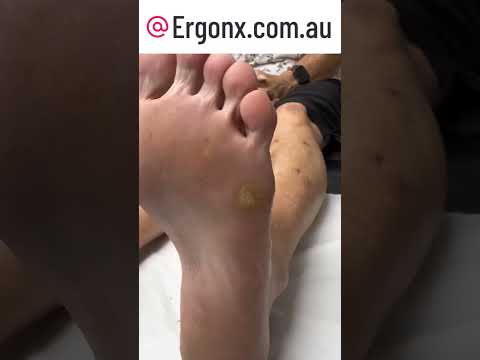 Ultimate Corn & Callus Removal by Aussie Podiatrist #FootCare #Australia