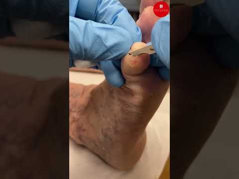 Say goodbye to that pesky corn! 🎉 Watch this satisfying removal and step into comfort like never