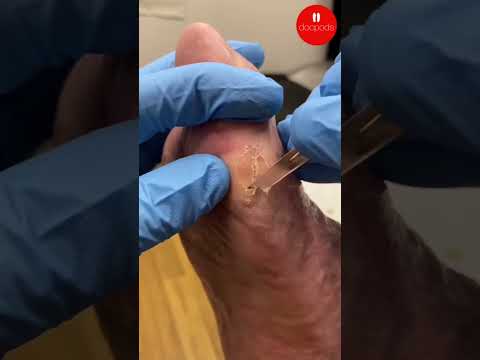 Tyloma on a Bunion: Causes and Podiatry Care