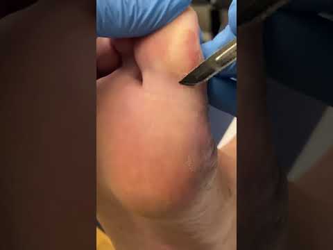 Say goodbye to stubborn calluses and hello to happy feet! Watch as a skilled podiatrist works magic