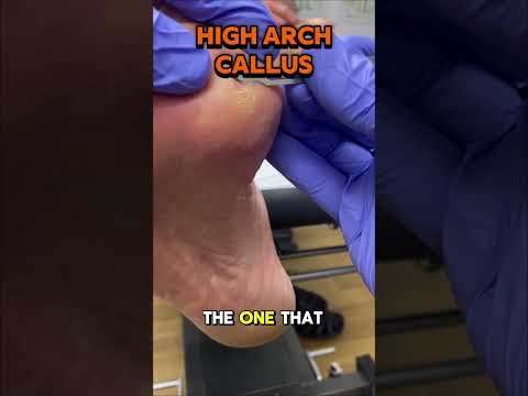 A satisfying treatment today removing a painful callus under the plantar fifth metatarsal head, with