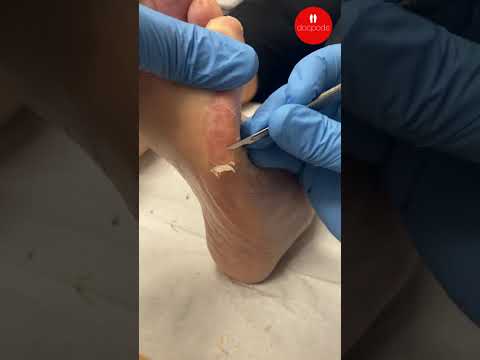How Podiatrists Treat Forefoot Calluses | ErgonX