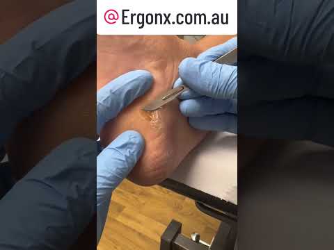 Expert Podiatrist Transforms Tough Heel Callus Safely #FootCare #Podiatry