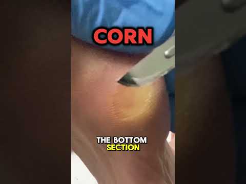 Removing a Corn Under the Fifth Metatarsal