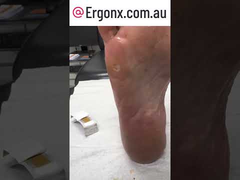 Watch a Satisfying Corn Removal by Podiatrist for Instant Relief #FeetCare #Podiatry