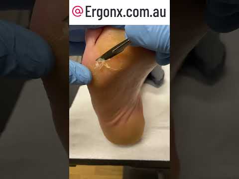 Ultimate Callus Cutting Satisfaction in Podiatry Clinic #Podiatry #Satisfying #CallusCare