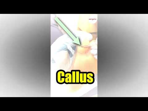 Big Toe Callus Removal by Podiatrist Expert Foot Care Magic #Podiatry #CallusRemoval