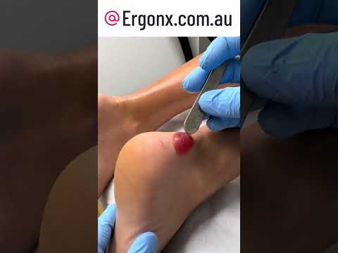 Epic Blood Blister After Marathon | See the Shocking Result! #Running #Marathon #Blister
