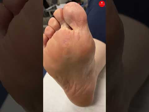 Painful Corn Debridement: How Podiatrists Help