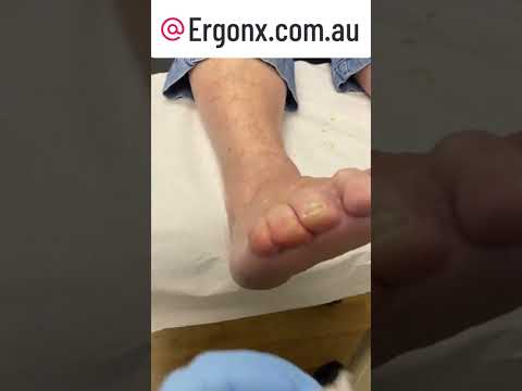 Satisfying Callus Removal Transformation | Podiatry Clinic ASMR #FootC ...