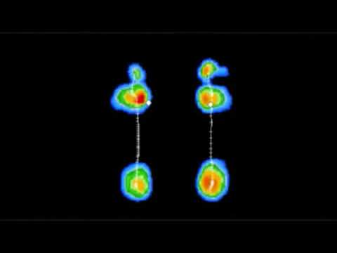 How Orthotic Insoles Help Manage Foot Pronation