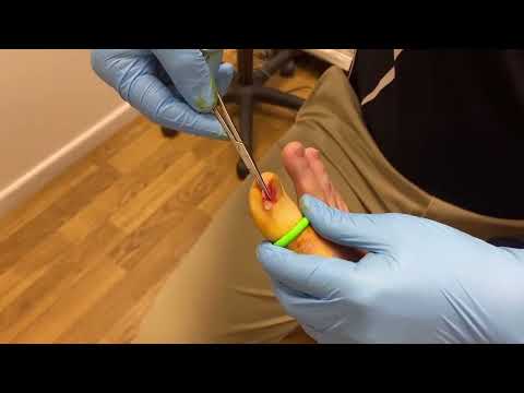 Watch this ingrown toenail transformation! 👣✨ Say goodbye to pain with our precise podiatry