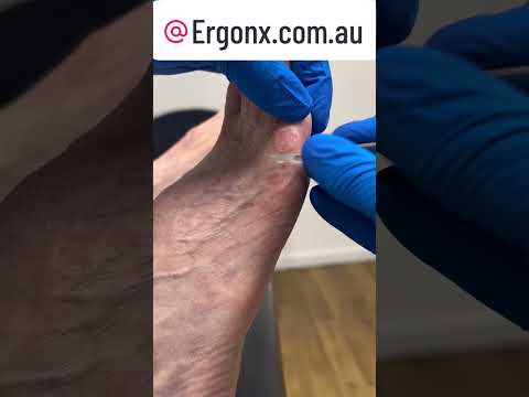 Satisfying Corn & Callus Removal by Podiatrist ASMR #FootCare #OddlySatisfying