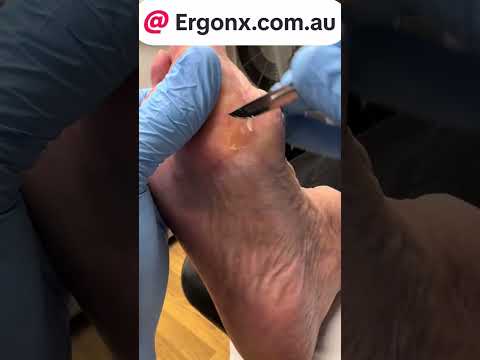 "Ultimate Relief: Tackling Painful Calluses from Work Boots #FootCare #WorkBoots"